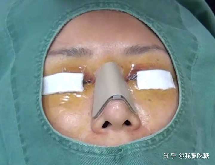 有没有做过鼻骨内推 内切和外切有什么区别啊 知乎