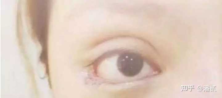 请问下三白眼如何改善呢? - 知乎