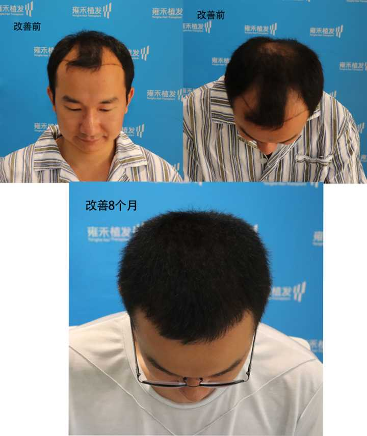 多岁的男生有一个m型发际线是怎样的体验 知乎