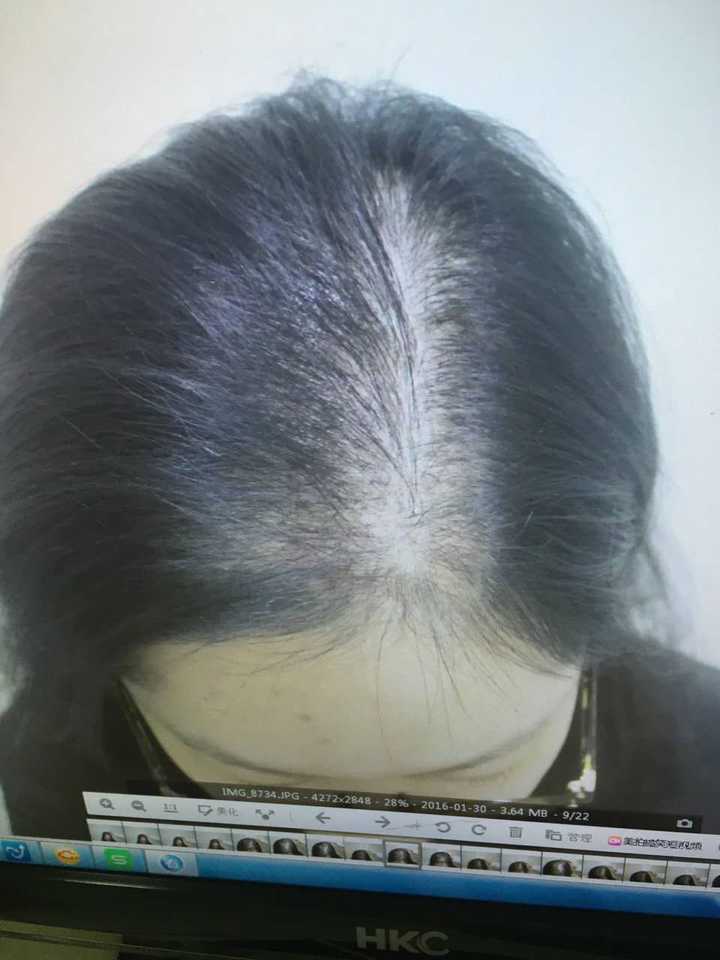 女性脂溢性脱发图片早期(脂溢性脱发头发还能长回来吗)