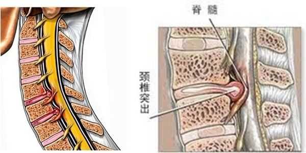 颈椎病 知乎