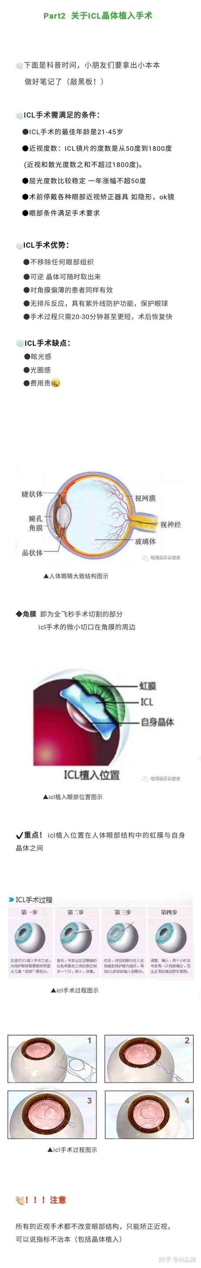 谁做过icl人工晶体植入手术 知乎