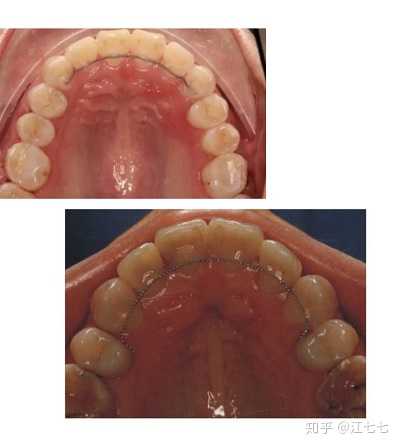 对发音影响很小;不过相对来说影响咬合,容易坏,寿命短,必须小心翼翼取