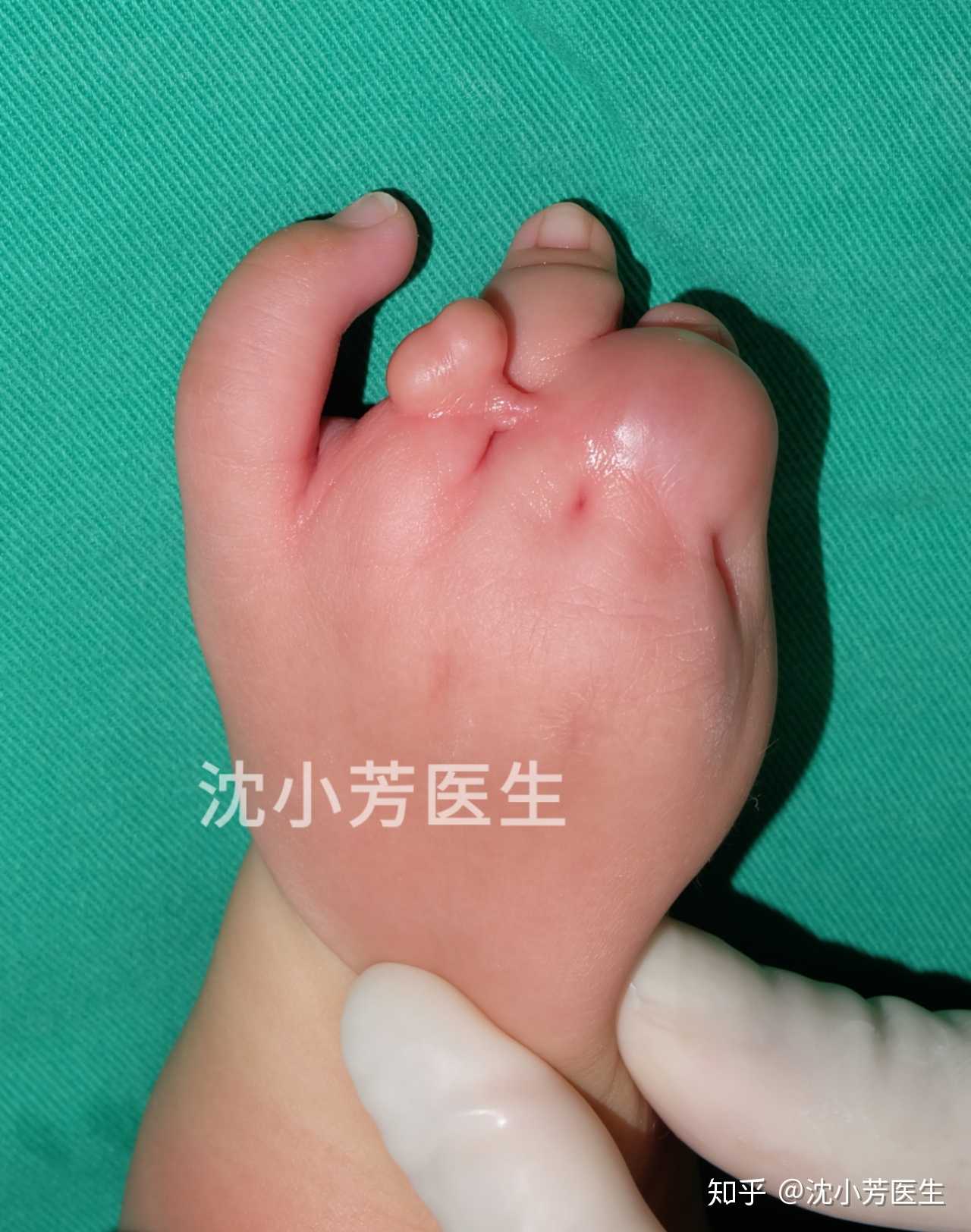 沈小芳医生 的想法: 这个孩子是左手束带综合症的患者,通过手