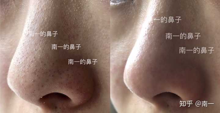 如何去除鼻子上的黑头 知乎