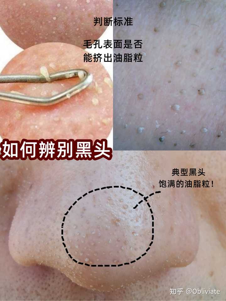 如果不管脸上的黑头,黑头会自己消失吗? - 知乎