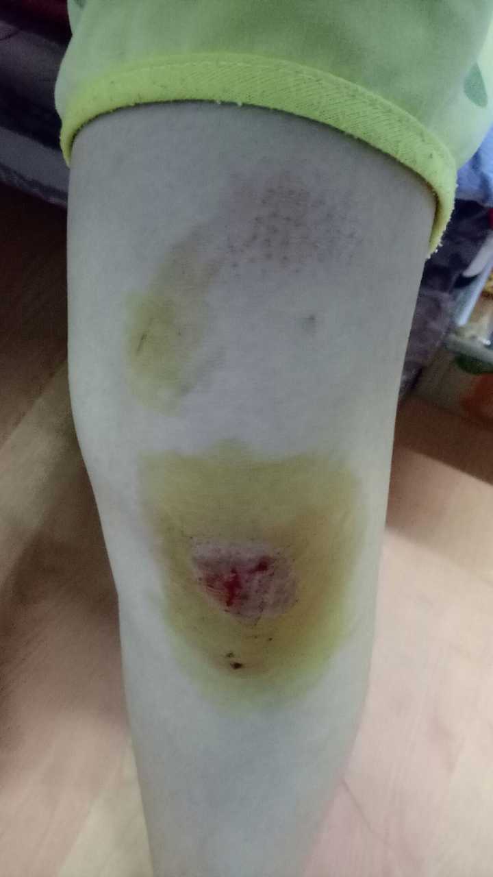 皮肤破后,流血结痂愈合是一个怎样的过程?