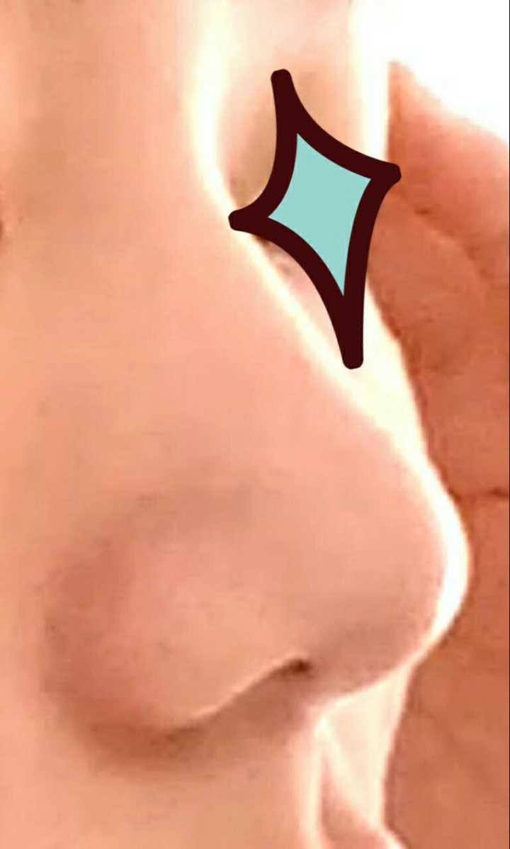 给你们一张鼻子的局部图