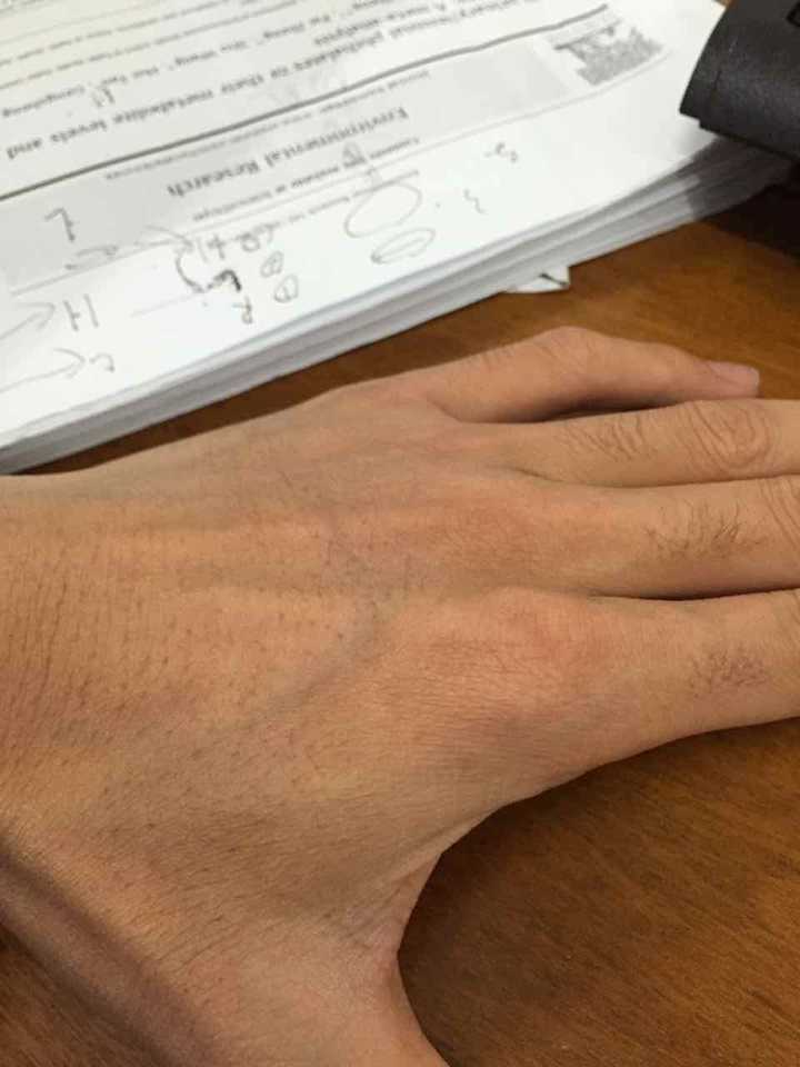 扁桃体几乎一个月一次发炎化脓怎么办? - 知乎