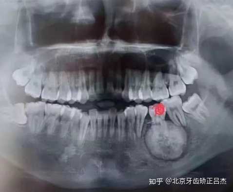 有沒有牙齒囊腫的