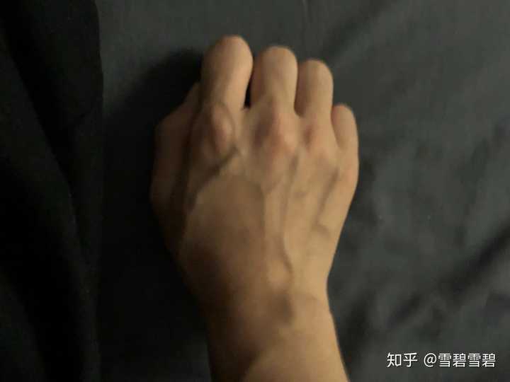 我一姑娘手青筋这般凸爆，以后会越来越严重吗？