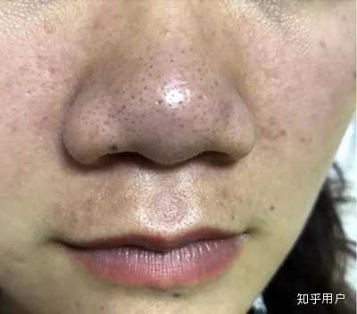 油皮毛孔粗大怎么改善? - 知乎