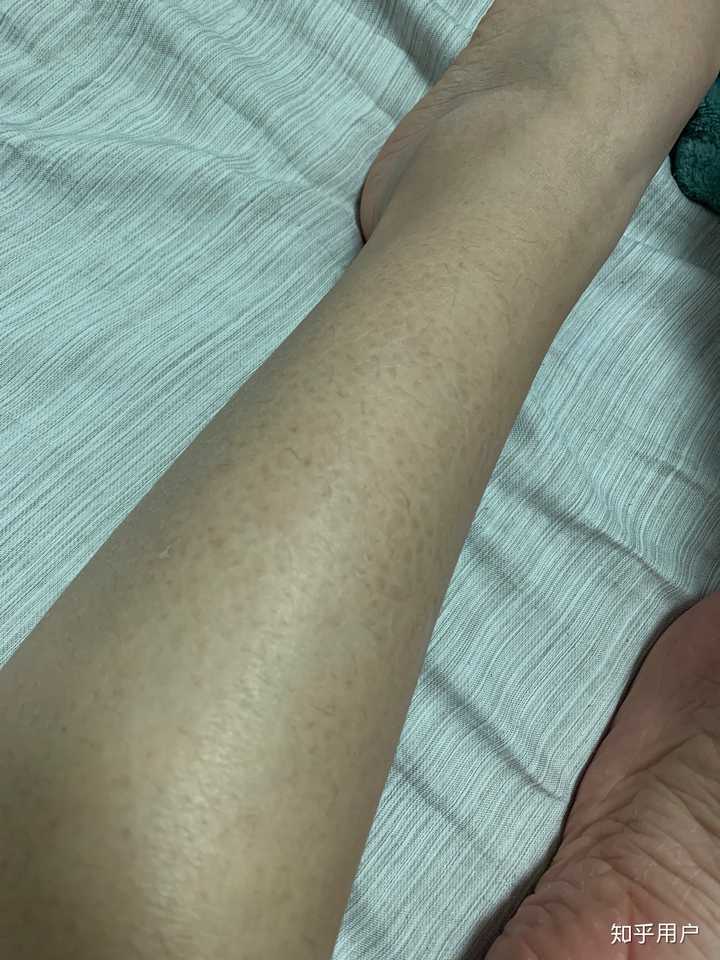 鱼鳞病还有未来吗 知乎 鱼鳞病还有未来吗 知乎