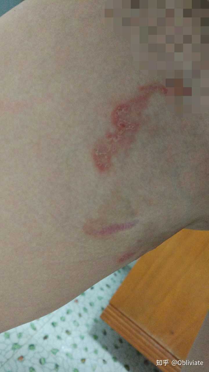 请问大家对股藓有怎样的经历与体会，股藓怎么根治？ 知乎 