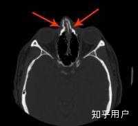 鼻骨骨折消肿后的复位是怎样进行的 如何矫正 知乎