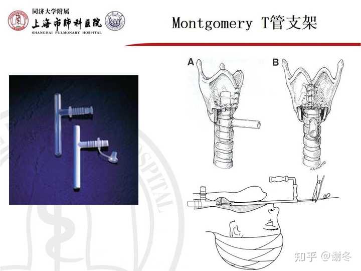 气管狭窄有哪些治疗方法? - 知乎