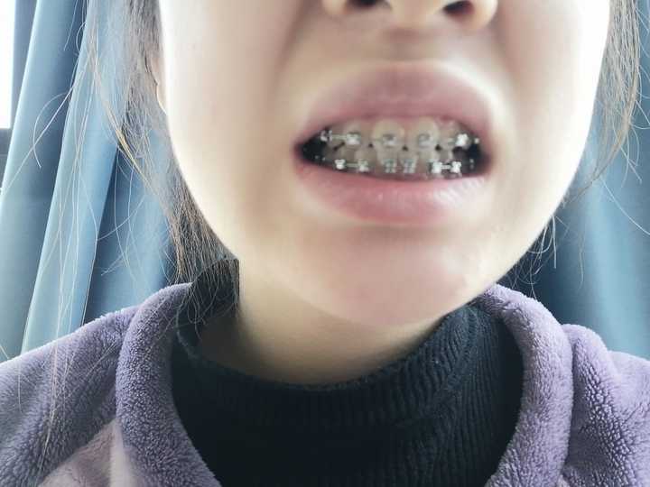 你们戴牙套一共花了多少钱?会后悔戴牙套吗?