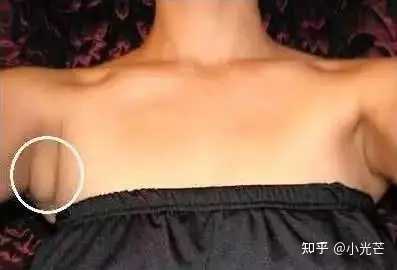 有人说副乳是乳腺癌的前兆，这个说法对吗？