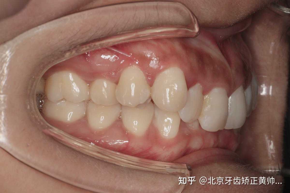 北京牙齿矫正黄帅医生 的想法: 内倾性深覆合会导致创伤性的咬合,由于