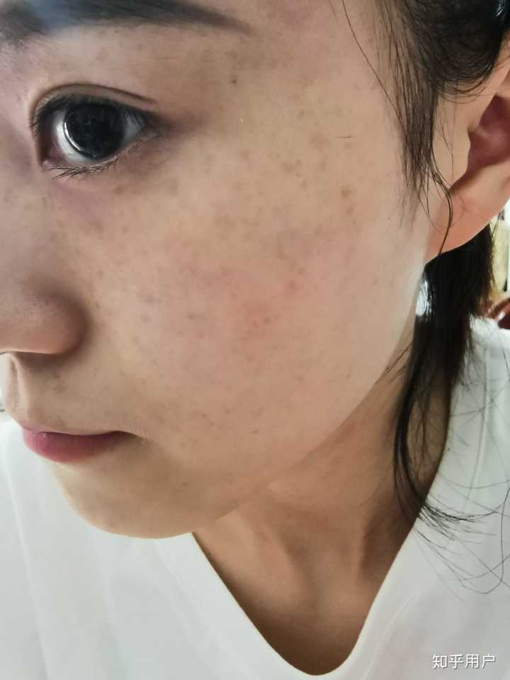 在中国,长雀斑会一点一点瓦解一个女孩的信心吗?