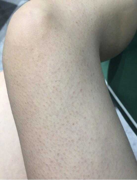得了鸡皮肤怎么办 知乎 得了鸡皮肤怎么办 知乎