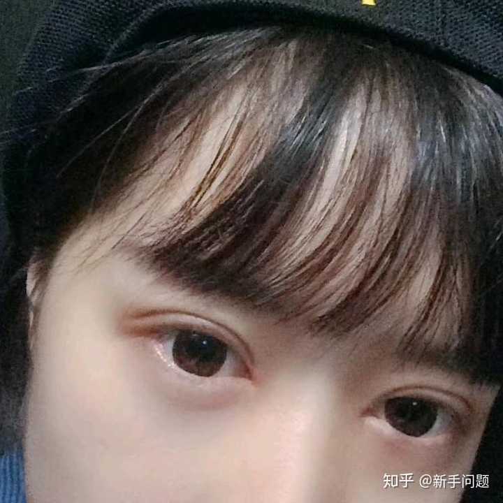 想知道有没有在福建省立医院丁力医生那里做过双眼皮的姐妹显示全部