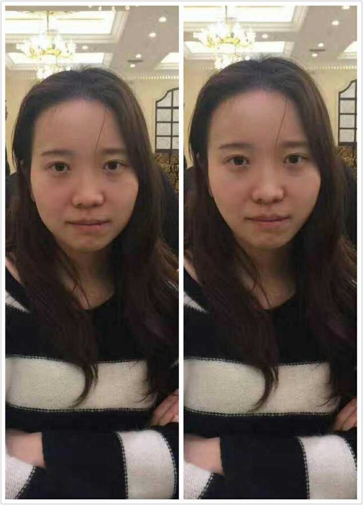 觉得山根低,想隆鼻,求帮忙看看还有什么地方需要整的(有图?