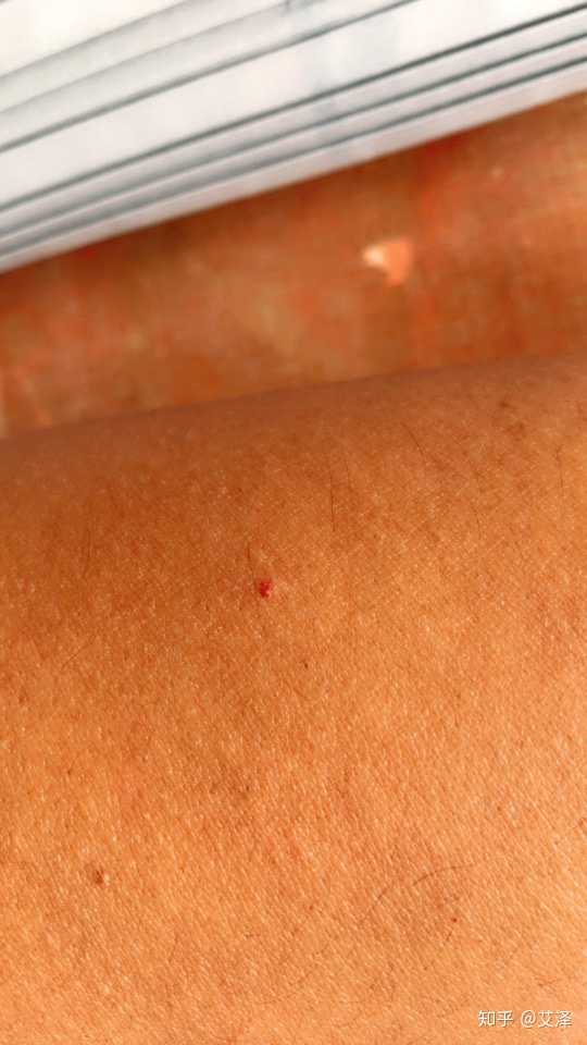 艾泽 的想法: 身上长血色红点不痒 - 知乎