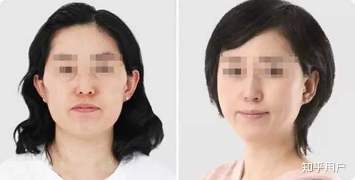 面部发腮怎么解决? - 知乎