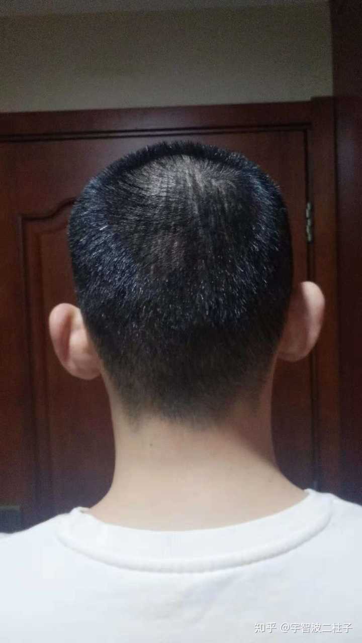 植发几年后的效果还会和刚植发的效果一样吗?