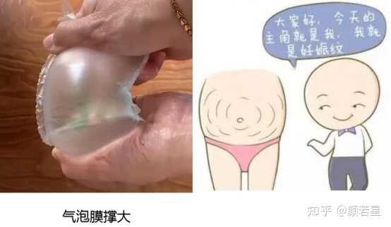 妊娠纹怎么去掉 有哪些防妊娠纹的用品推荐 知乎