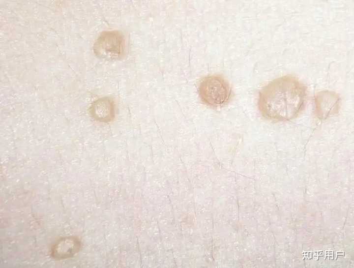 为什么好多人说扁平疣不需要过度治疗,让它自生自灭? - 知乎