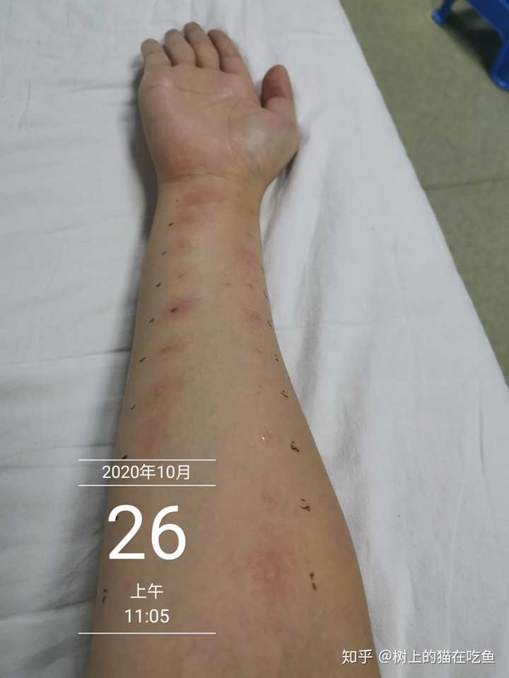 查过敏源需多少钱 知乎 查过敏源需多少钱 知乎