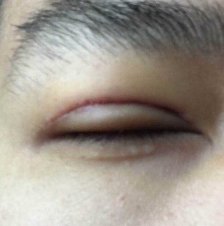 全切双眼皮价格_双眼皮的价格_郑大一附院割双眼皮价格
