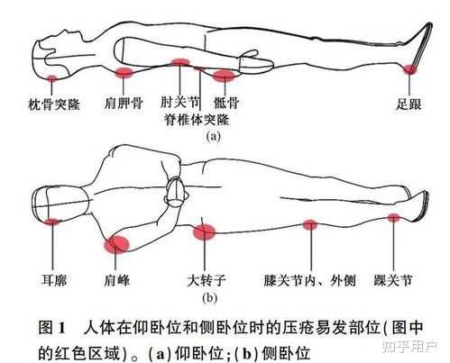 压疮的分期及临床表现是什么? - 知乎