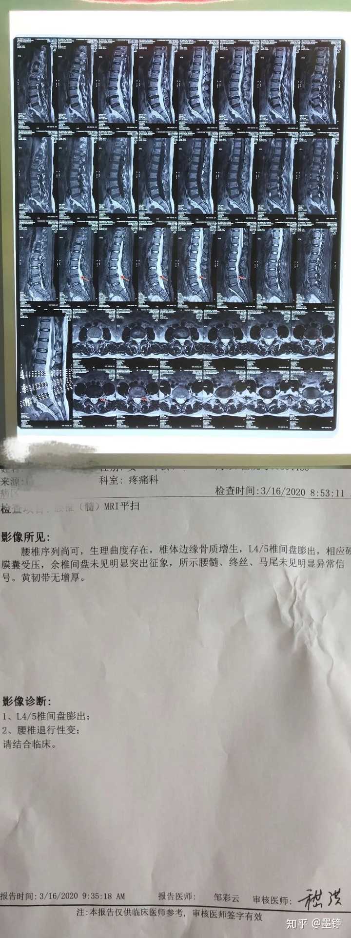 女性腰椎间盘膨出图片图片