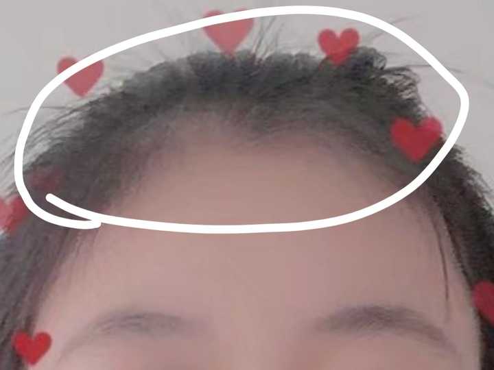 请问女生有美人尖可以留刘海吗。会不会不好打理。或者必须要烫或者定型才可以？