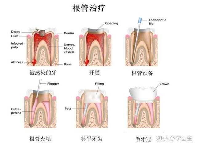 根管治疗有什么副作用吗 知乎