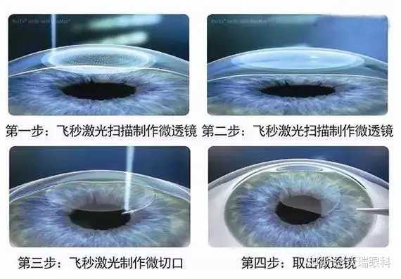 全飞秒激光手术安全吗 知乎 全飞秒激光手术安全吗 知乎