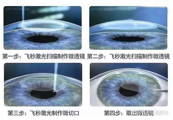 全飞秒激光手术安全吗 知乎