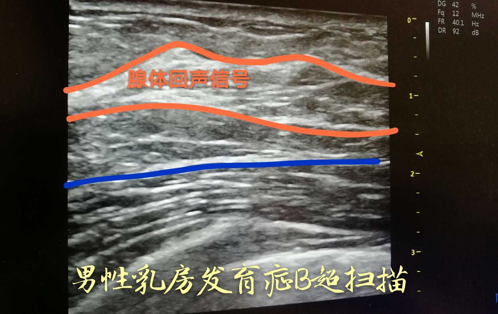 男性乳房发育症 患者受多年的女乳型外 知乎