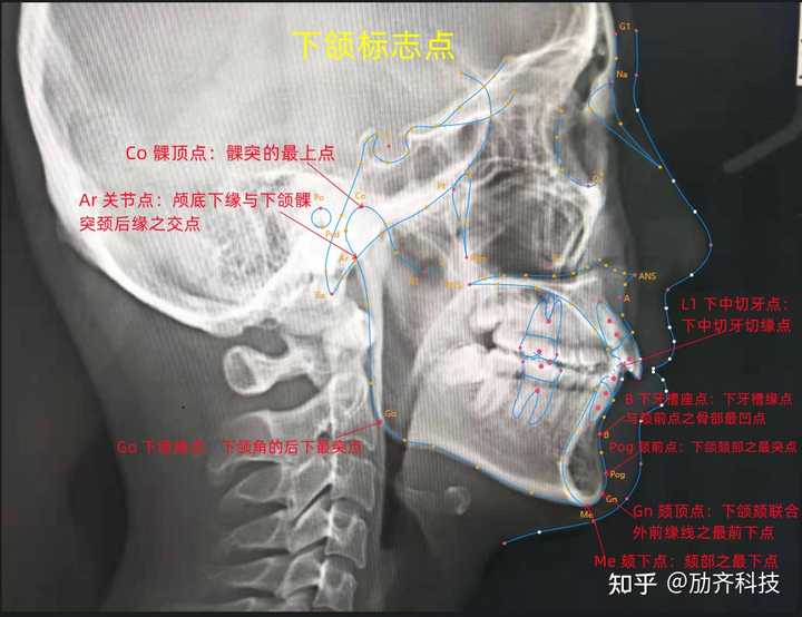 做正畸患者测的头颅侧位片的各种参数各代表什么意思啊，好难懂啊？ - 知乎