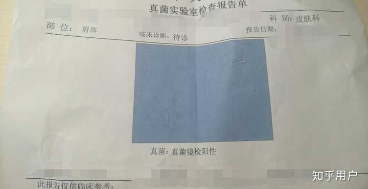 今年八月去医院做了真菌检查得出呈阳性