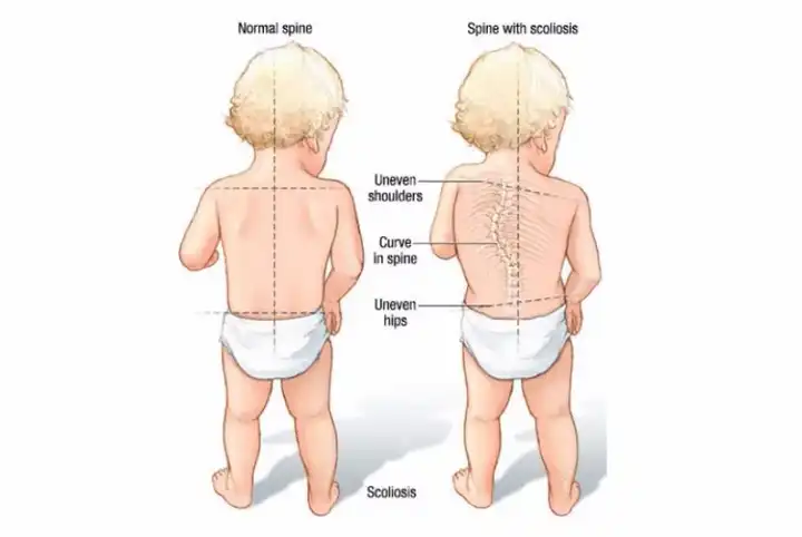 脊椎先天发育有问题,也可能同时合并其他器官异常出现脊椎弯曲 2