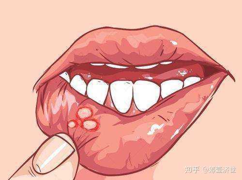 舌头痛怎么办 知乎