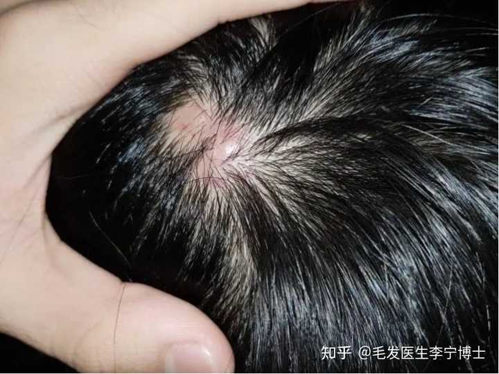 得了毛囊炎,头发还能再长吗?毛囊炎有哪些临床表现? - 知乎