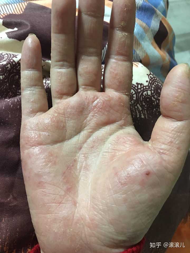 手部湿疹能根治吗?