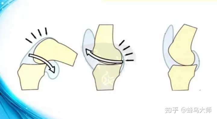 膝关节弹响是什么原因造成的,有什么方法恢复?