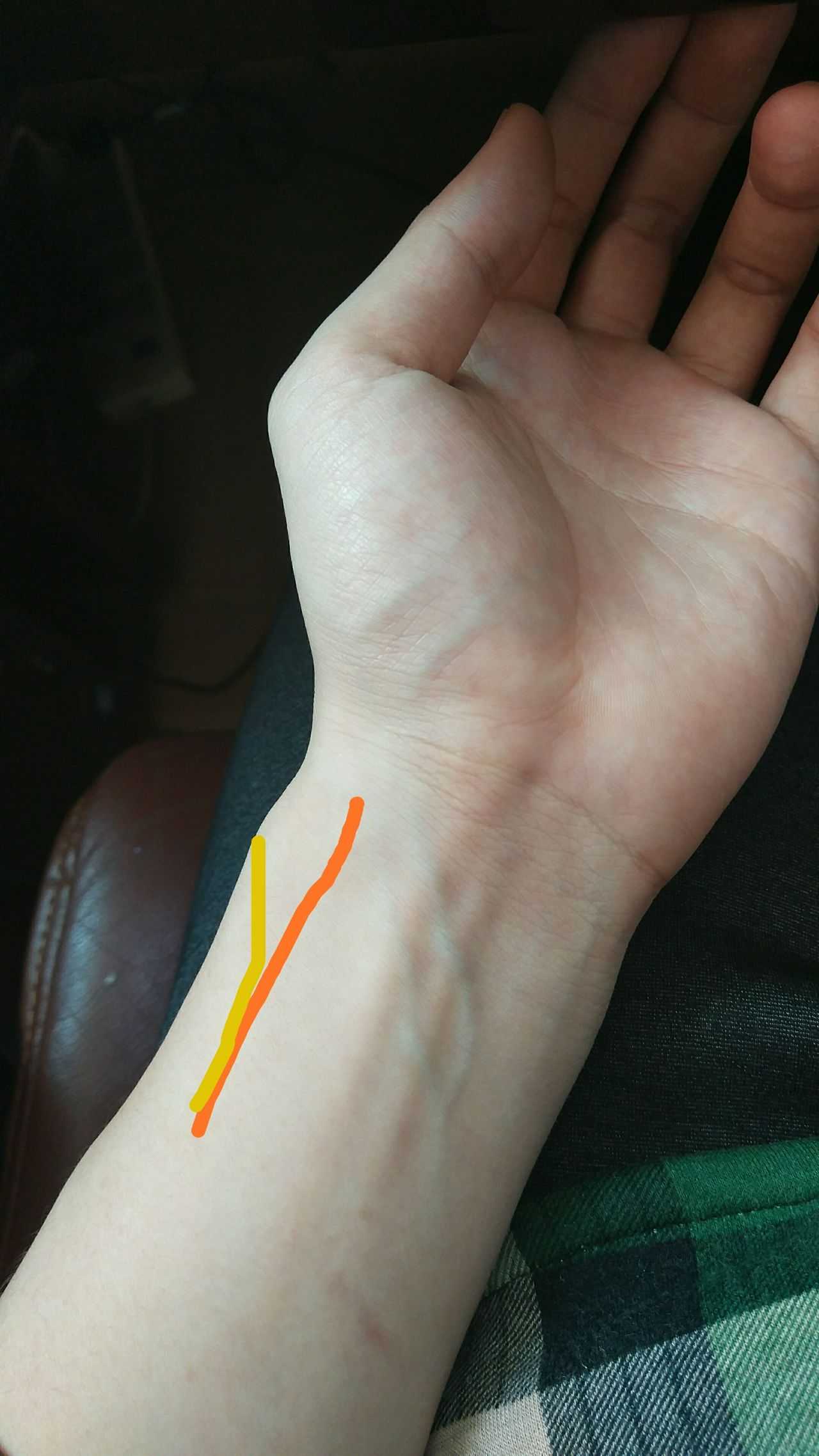 反关脉 我左手桡动脉和正常人的位置不一样.