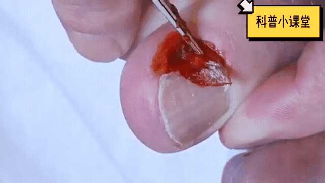 指甲被连根拔起是什么体验?